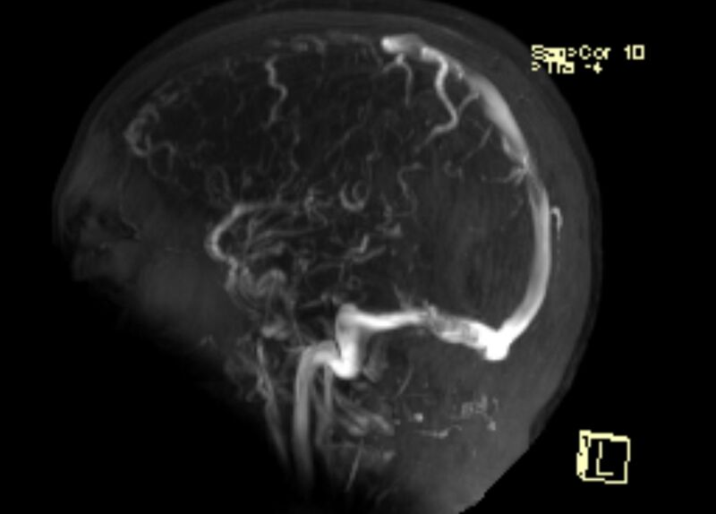 File:Cerebral venous infarct (Radiopaedia 53627-59723 3D MRV 1).jpg
