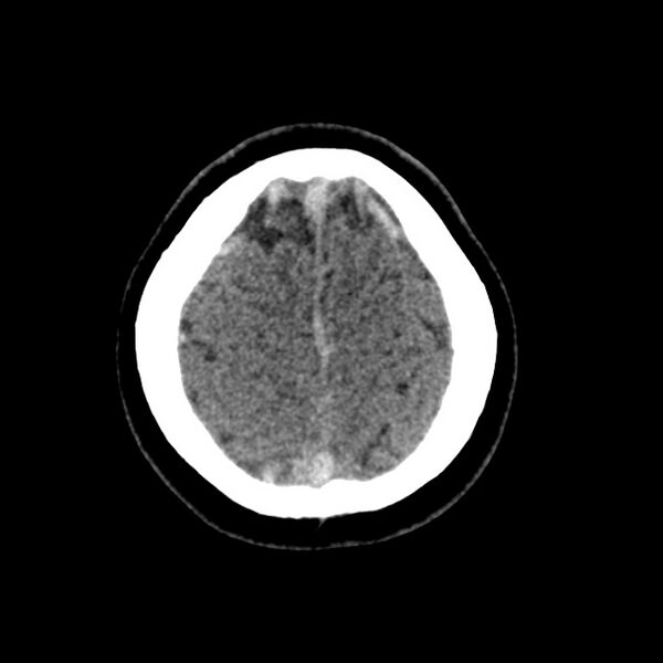 File:Cerebral venous sinus thrombosis (Radiopaedia 59224-66551 Axial non-contrast 47).jpg