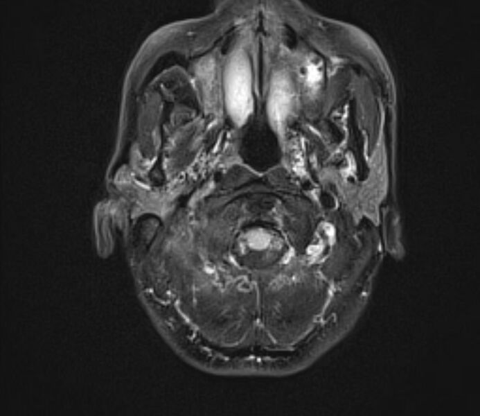 File:Cerebral venous thrombosis (Radiopaedia 71207-81504 Axial FLAIR 3).jpg