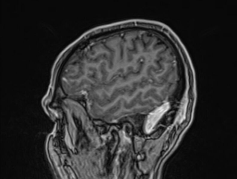 File:Cerebral venous thrombosis (Radiopaedia 71207-81504 Sagittal T1 C+ 54).jpg
