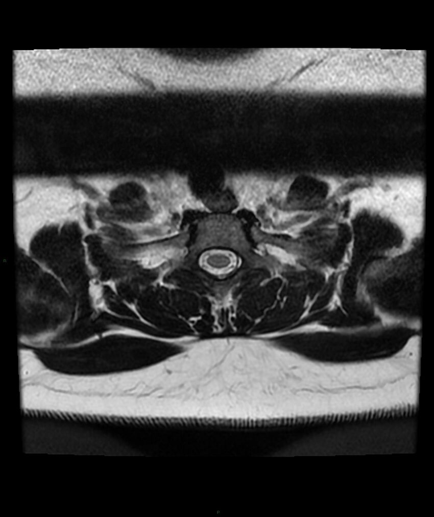 Cervical disc prolapse (Radiopaedia 80258-93598 Axial T2 80).jpg