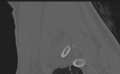 Cervical disc replacement (Radiopaedia 37383-39205 Sagittal bone window 14).png