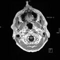 Cervical dural CSF leak on MRI and CT treated by blood patch (Radiopaedia 49748-54995 Axial T1 C+ 11).jpg
