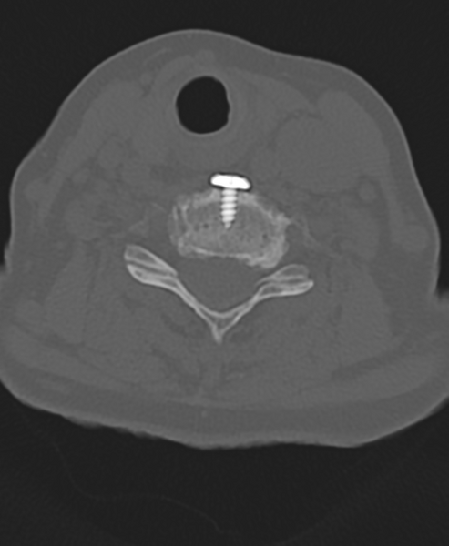File:Cervical spine ACDF loosening (Radiopaedia 48998-54071 Axial bone window 40).png