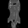 Cervical spine fractures with vertebral artery dissection (Radiopaedia 32135-33078 Coronal bone window 2).jpg