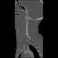 Cervical spine fractures with vertebral artery dissection (Radiopaedia 32135-33078 Sagittal bone window 29).jpg