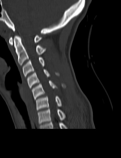 File:Cervical spine posterior ligamentous complex rupture (Radiopaedia 63486-72101 Sagittal bone window 14).jpg