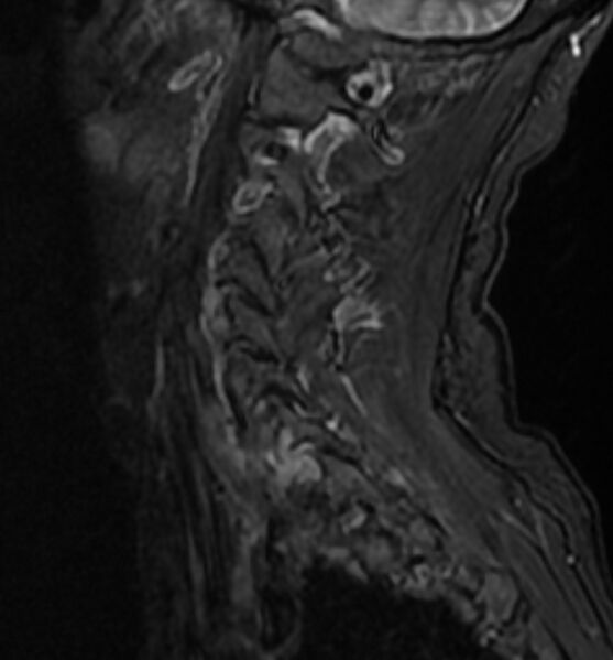 File:Cervical spondylodiscitis (Radiopaedia 81362-95110 Sagittal STIR 3).jpg