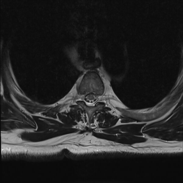 File:Cervical tumor-like myelopathy due to Type V dAVF (Radiopaedia 82461-96604 D 9).jpg