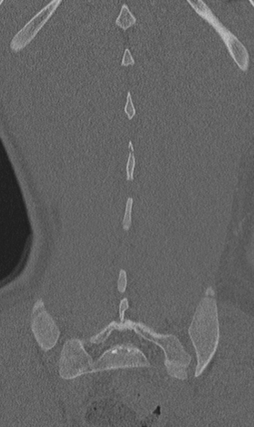 File:Chance fracture (Radiopaedia 40360-42912 Coronal bone window 60).png