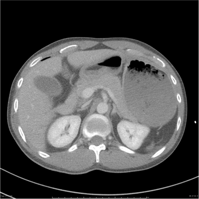 Chest and abdomen multi-trauma (Radiopaedia 26294-26426 bone window 27).jpg