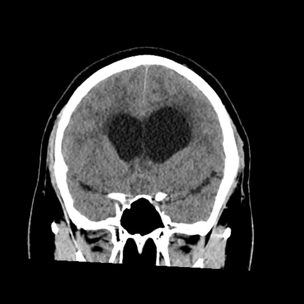 File:Chiasmatic-hypothalamic juvenile pilocytic astrocytoma (Radiopaedia 78533-91237 Coronal non-contrast 27).jpg