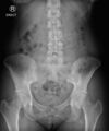 Cholelithiasis (x-ray) (Radiopaedia 64797).jpg