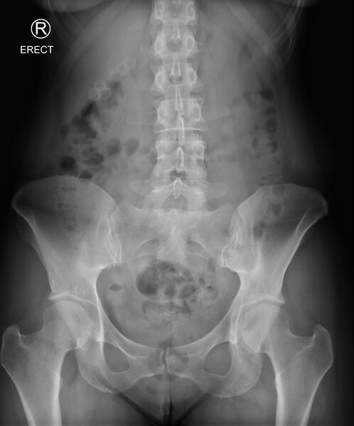 File:Cholelithiasis (x-ray) (Radiopaedia 64797).jpg