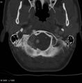 Chondroblastoma - occipital condyle (Radiopaedia 5569-7304 bone window 4).jpg
