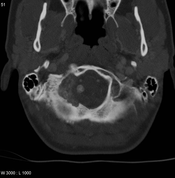 File:Chondroblastoma - occipital condyle (Radiopaedia 5569-7304 bone window 4).jpg