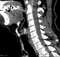 Chondrosarcoma - larynx (Radiopaedia 4588-6698 C 6).jpg