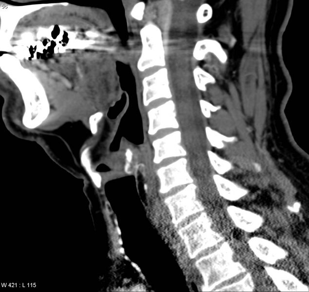 File:Chondrosarcoma - larynx (Radiopaedia 4588-6698 C 6).jpg