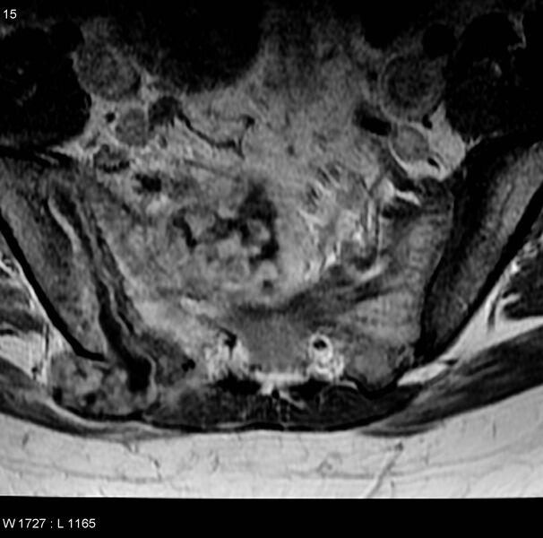 File:Chondrosarcoma - sacrum (Radiopaedia 6173-7627 Axial T1 C+ 2).jpg