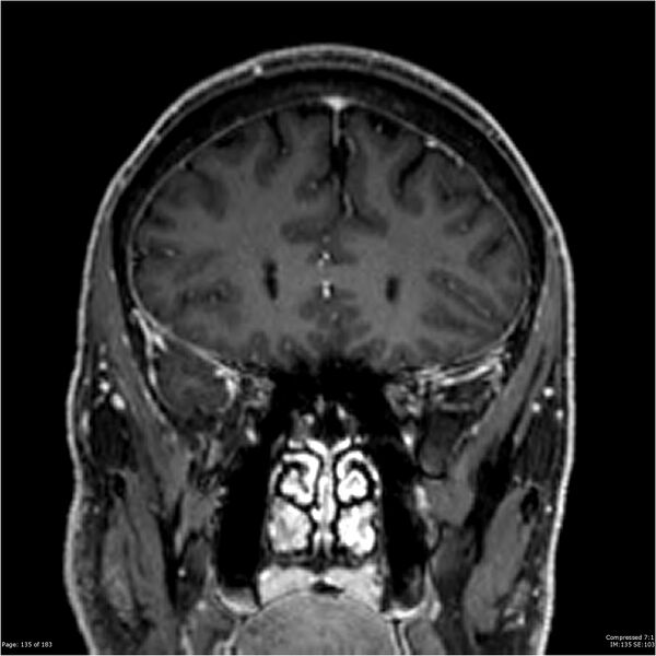 File:Chondrosarcoma of skull base- grade II (Radiopaedia 40948-43654 Coronal T1 C+ 46).jpg