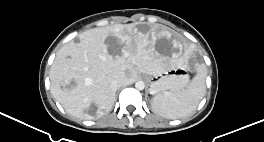 Choriocarcinoma liver metastases (Radiopaedia 74768-85766 A 50).jpg
