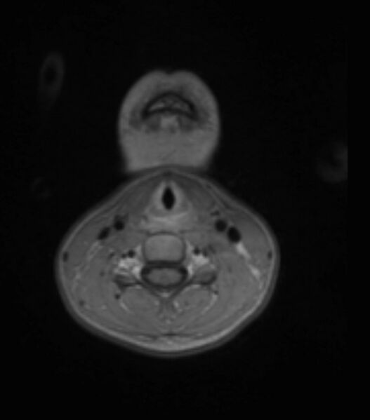 File:Choroid plexus carcinoma (Radiopaedia 91013-108553 Axial T1 C+ 7).jpg