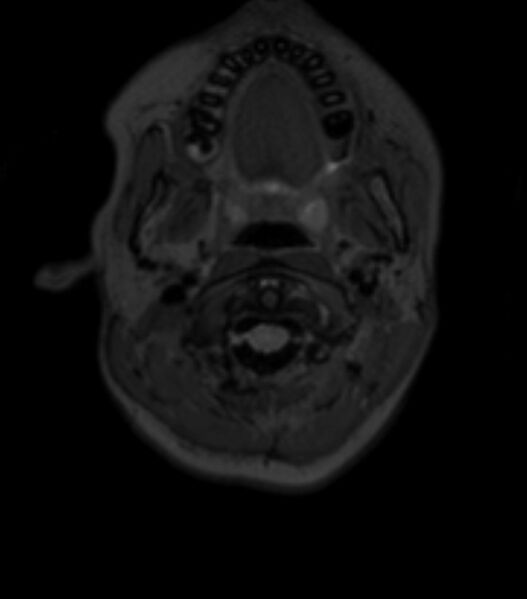 File:Choroid plexus carcinoma (Radiopaedia 91013-108553 Axial T2 fat sat 19).jpg