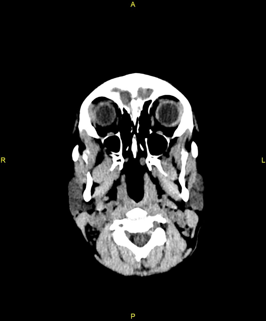 Choroidal fissure cyst (Radiopaedia 89481-106465 Axial non-contrast 9).jpg