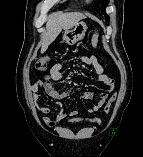 File:Chromophobe renal cell carcinoma (Radiopaedia 84286-99573 H 43).jpg
