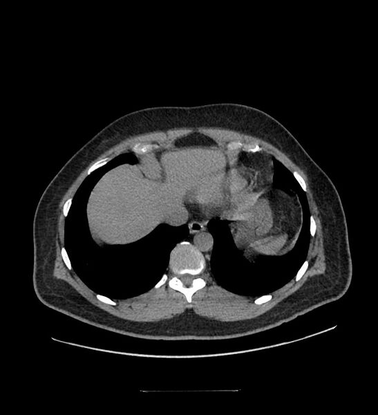 File:Chromophobe renal cell carcinoma (Radiopaedia 84337-99644 Axial non-contrast 8).jpg
