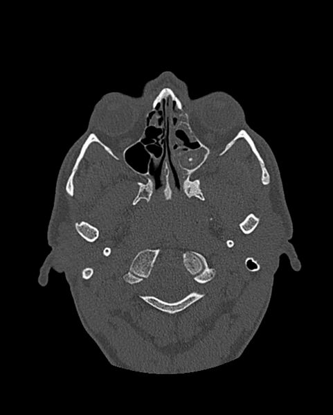 File:Chronic maxillary sinusitis caused by a foreign body (Radiopaedia 58521-65676 Axial bone window 172).jpg