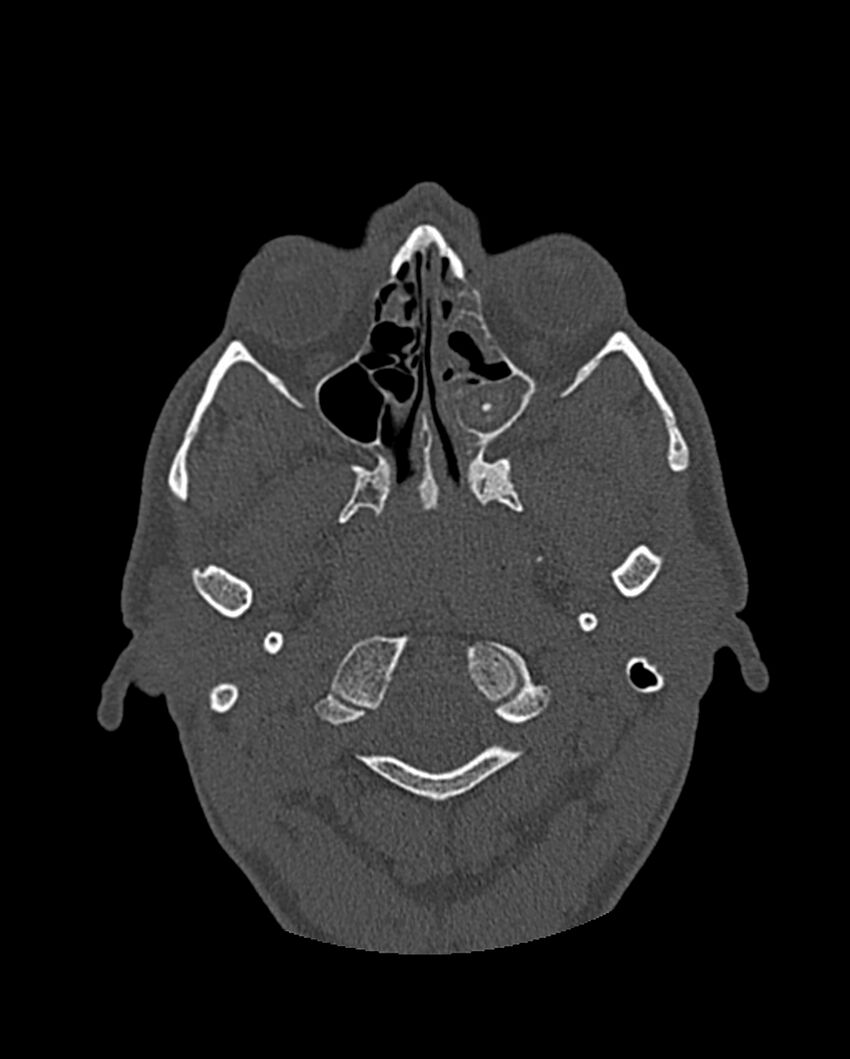 Chronic maxillary sinusitis caused by a foreign body (Radiopaedia 58521-65676 Axial bone window 172).jpg