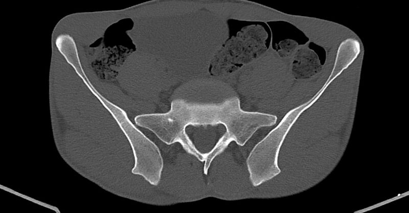 File:Chronic osteomyelitis (with sequestrum) (Radiopaedia 74813-85822 Axial non-contrast 2).jpg