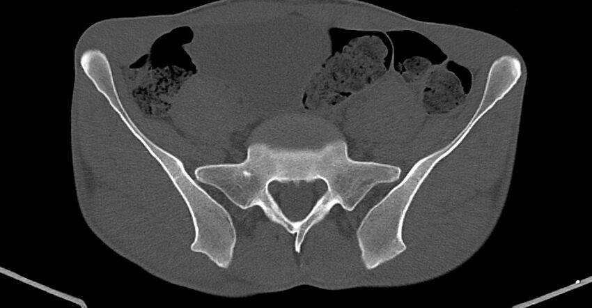 Chronic osteomyelitis (with sequestrum) (Radiopaedia 74813-85822 Axial non-contrast 2).jpg