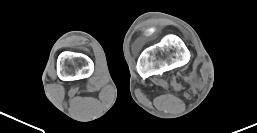 Chronic osteomyelitis (with sequestrum) (Radiopaedia 74813-85822 D 172).jpg