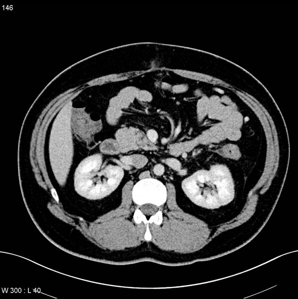 File:Chronic pancreatitis and pseudocysts (Radiopaedia 6724-7935 D 11).jpg