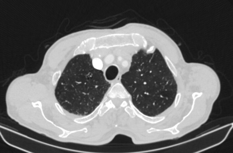 File:Chronic pulmonary embolism (Radiopaedia 91241-108843 Axial lung window 15).jpg