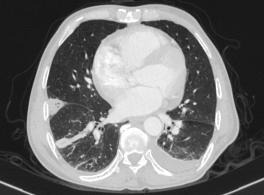 Chronic pulmonary embolism with bubbly consolidation (Radiopaedia 91248-108850 Axial lung window 102).jpg