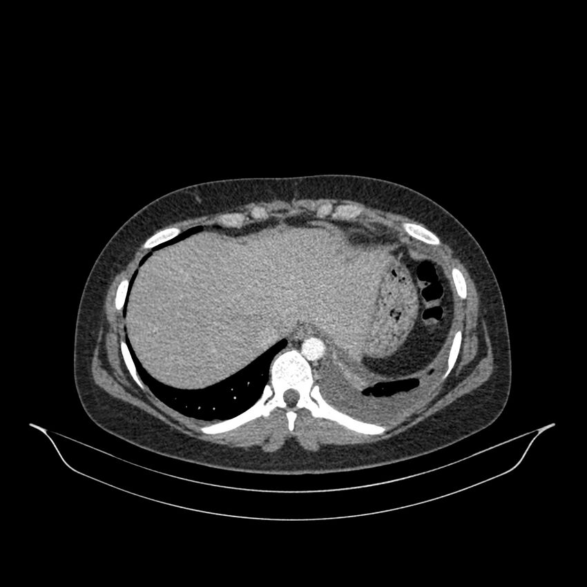 Chronic thromboembolic pulmonary hypertension (CTEPH) (Radiopaedia 74597-85532 Axial C+ CTPA 31).jpg