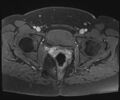 Class II Mullerian duct anomaly- unicornuate uterus with rudimentary horn and non-communicating cavity (Radiopaedia 39441-41755 Axial T1 fat sat 103).jpg