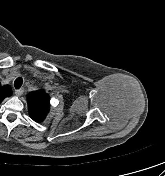 File:Clear cell chondrosarcoma - humerus (Radiopaedia 63104-71612 Axial non-contrast 31).jpg
