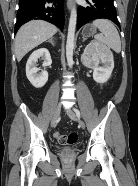 File:Clear cell renal cell carcinoma (Radiopaedia 61449-69393 F 27).jpg