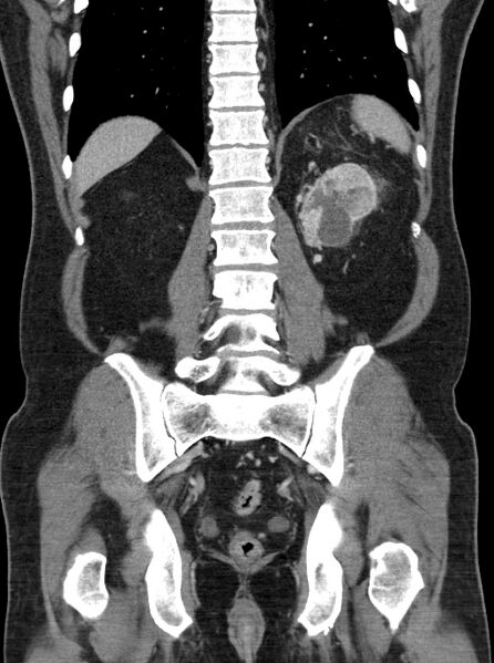 File:Clear cell renal cell carcinoma (Radiopaedia 61449-69393 F 40).jpg
