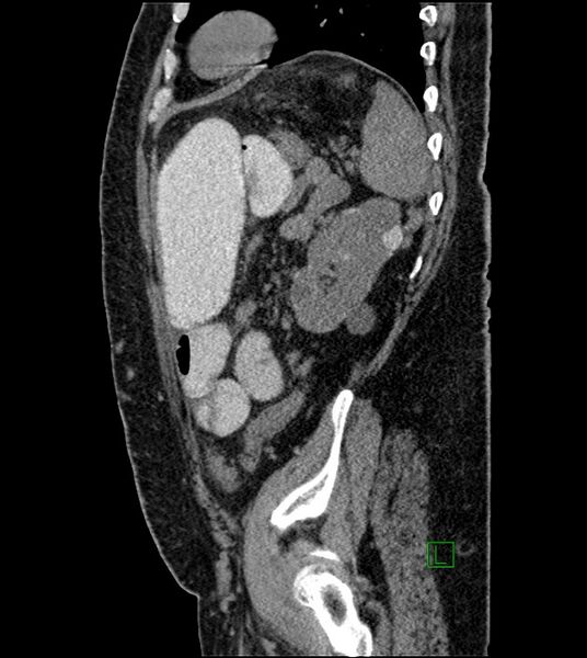 File:Closed-loop small bowel obstruction-internal hernia (Radiopaedia 78439-91096 C 42).jpg