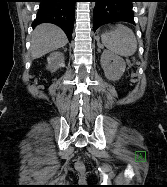File:Closed-loop small bowel obstruction-internal hernia (Radiopaedia 78439-91096 Coronal non-contrast 78).jpg
