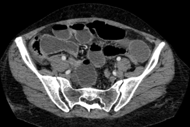 File:Closed loop small bowel obstruction (Radiopaedia 71211-81508 A 115).jpg