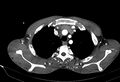 Coarctation of aorta with aortic valve stenosis (Radiopaedia 70463-80574 A 12).jpg