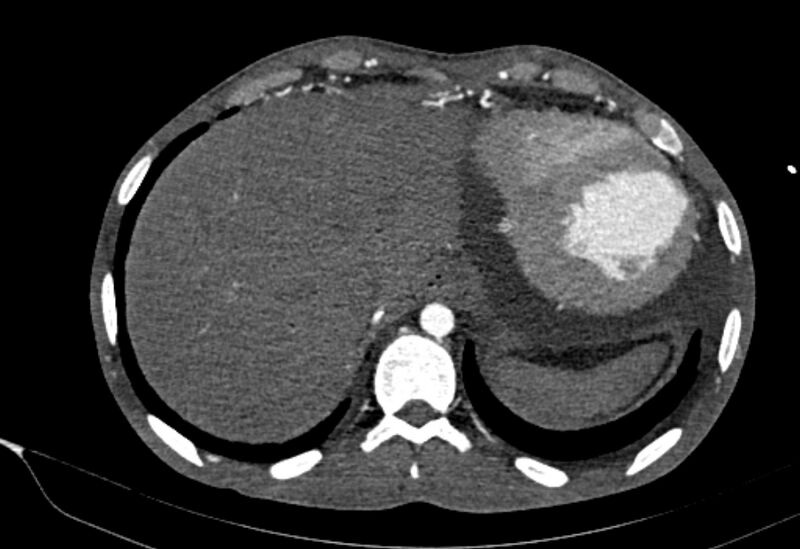 File:Coarctation of aorta with aortic valve stenosis (Radiopaedia 70463-80574 A 205).jpg