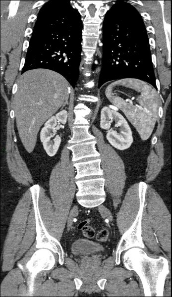 File:Coarctation of the aorta (Radiopaedia 74632-88521 B 157).jpg