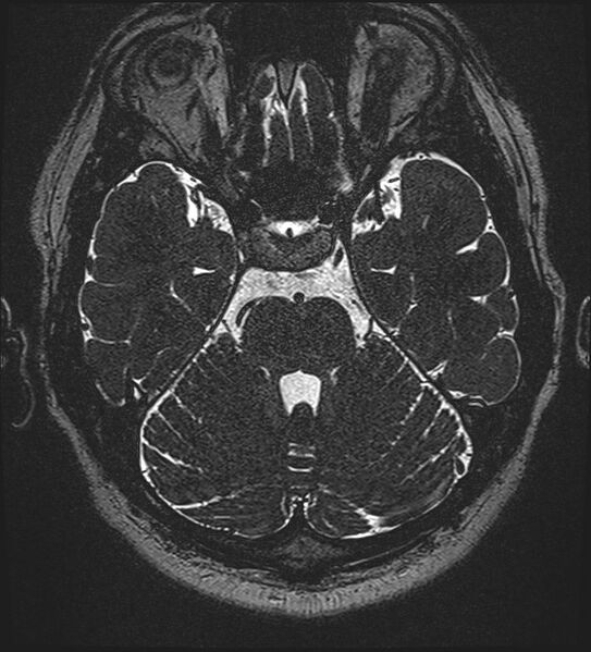 File:Cochlear incomplete partition type III associated with hypothalamic hamartoma (Radiopaedia 88756-105498 Axial T2 112).jpg